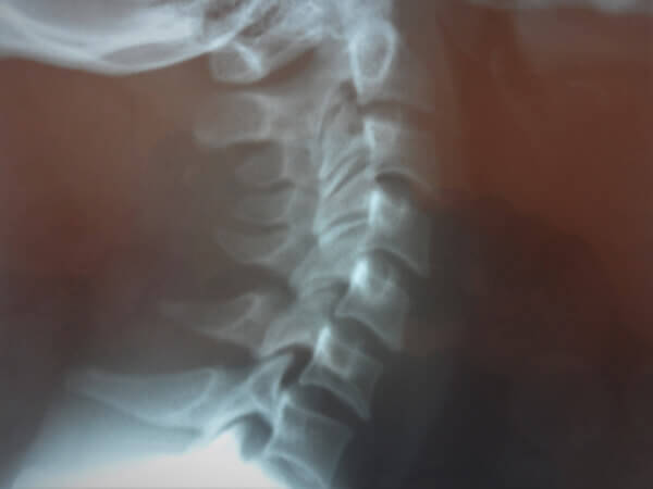 renu health chiropractic X-ray-Image